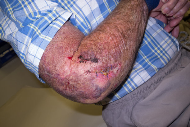 缝合了一个老人的手臂伤口图片下载