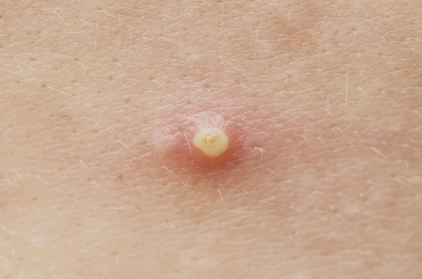 痤疮的宏观，痘痘的特写图片下载