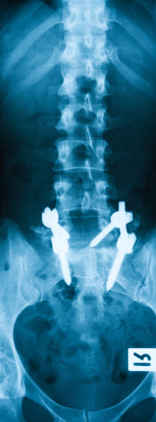 腰骶(L-S)脊柱x线平扫图片下载