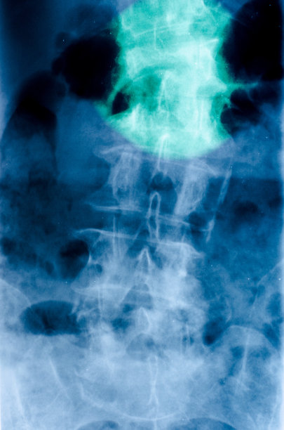 腰椎骨折图片下载