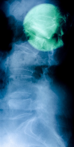 腰椎骨折图片下载