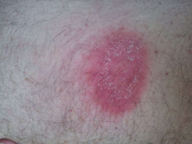 萎缩性肢端皮炎，莱姆病，莱姆病图片下载