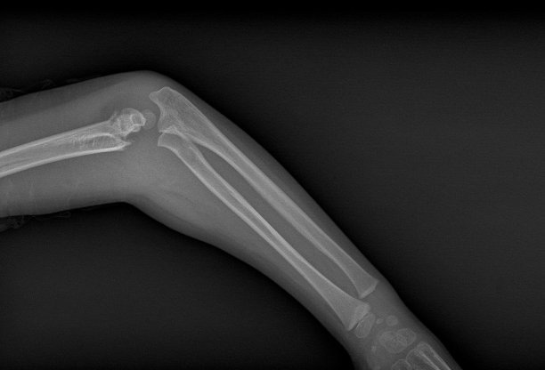 手臂骨折x光图片下载
