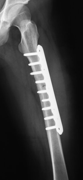 股骨骨折x线照片。图片下载