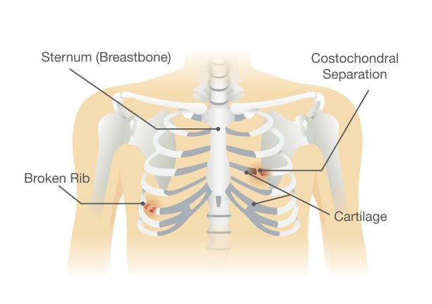 人肋骨骨折骨折。图片下载