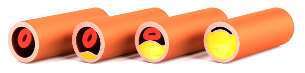 含有胆固醇的血管图片下载