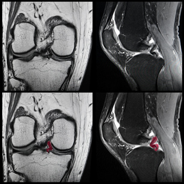 半月板撕裂,核磁共振图片下载