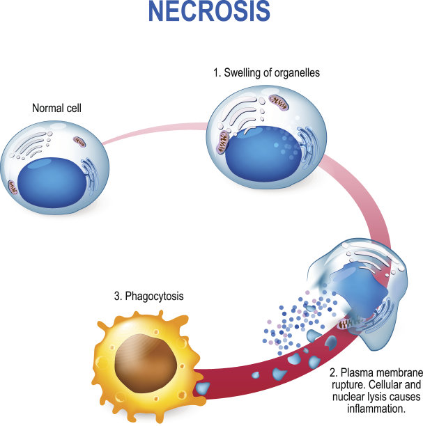 坏死的过程图片下载