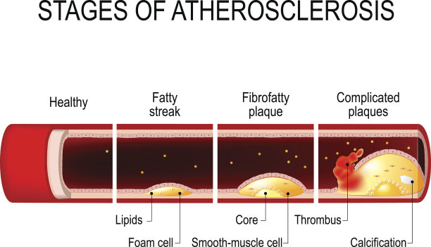 阶段的动脉粥样硬化图片下载