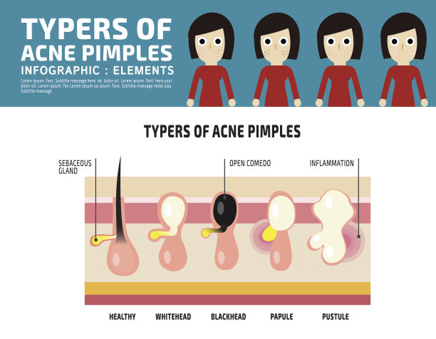 类型的解剖痤疮丘疹信息图表元素图片下载