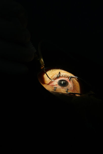 白内障手术图片下载