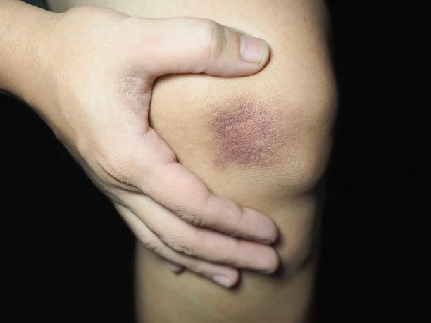 受伤的膝盖图片下载