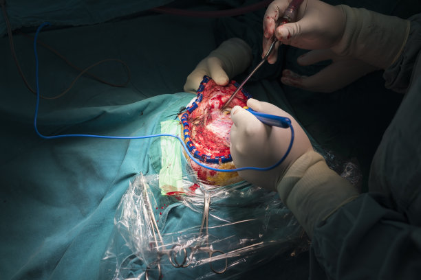 颅骨成形术图片下载