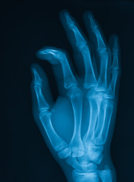 手x光图像，PA视图，图片下载