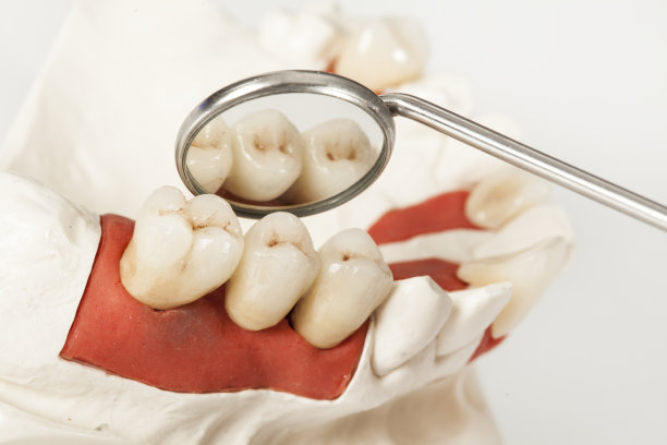 石膏模型上的陶瓷桥图片下载