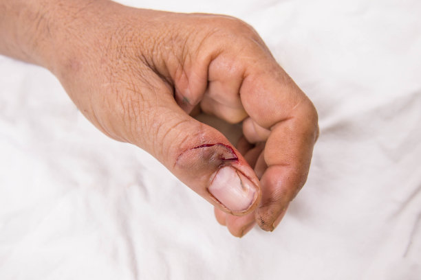 受伤的手指和肮脏的开放性伤口图片下载