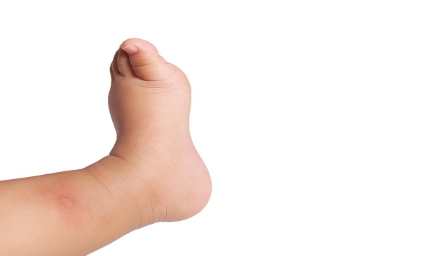 女婴腿上有多处蚊虫叮咬，图片下载