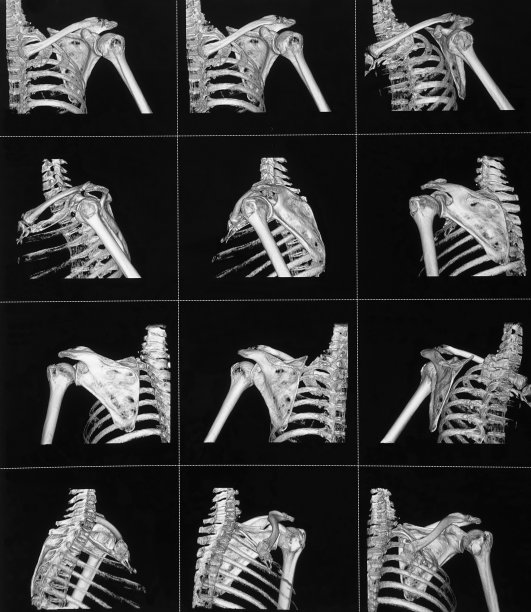 特殊摄影，肩部x线CT扫描，三维图像图片下载