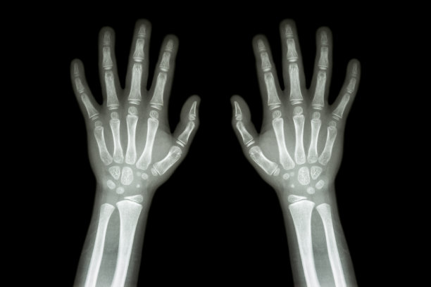 儿童双手x光片正常图片下载