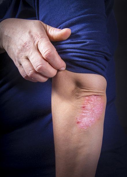 牛皮癣在肘部图片下载