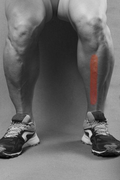 胫骨骨膜炎图片下载