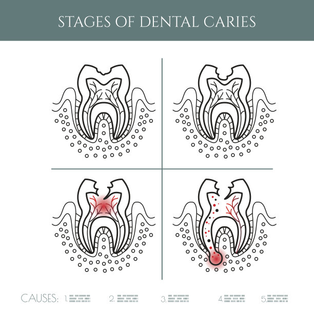 龋齿阶段图片下载