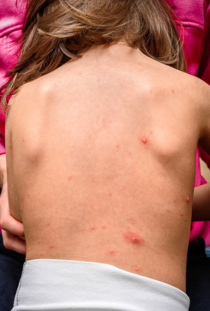 水痘带状疱疹病毒或水痘泡疹对儿童、婴儿素材图片