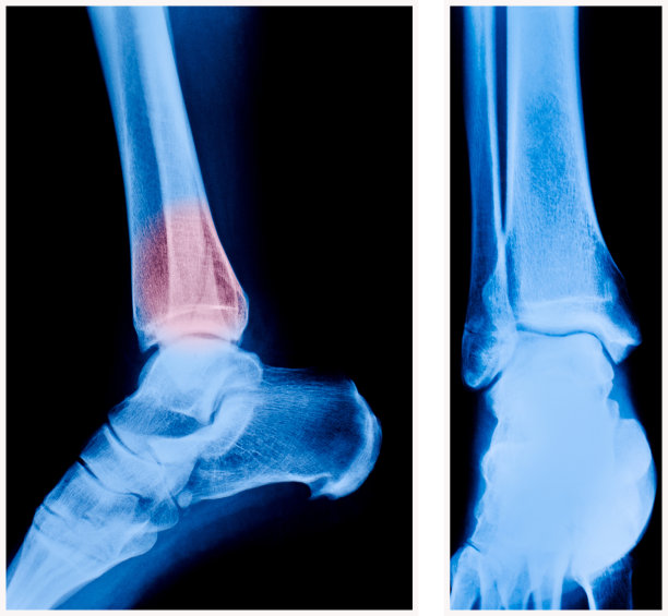 踝关节x光片图片下载