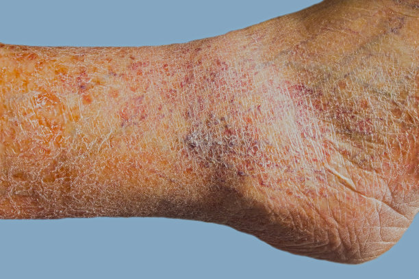 皮肤静脉曲张的特写素材图片