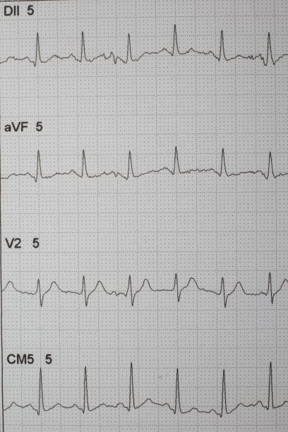 心电图图片下载