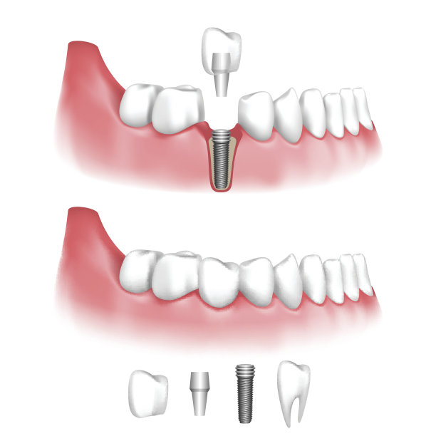 牙科植体图片下载