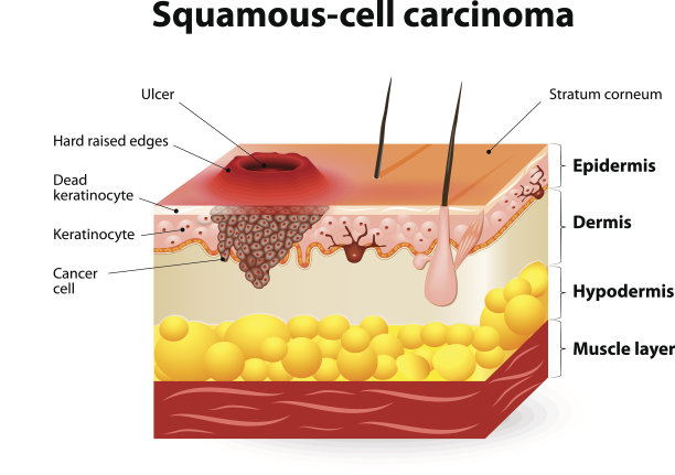 鳞状细胞癌图片下载