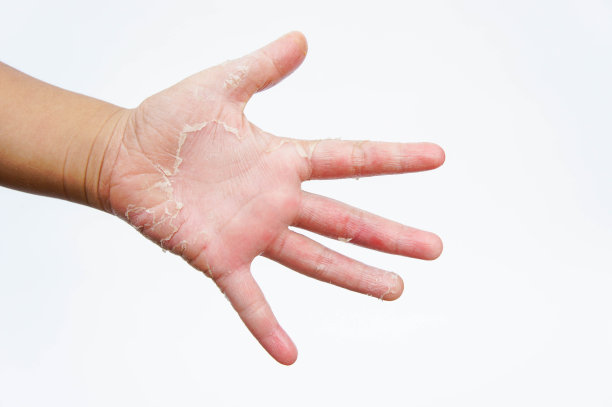 手干燥，脱皮，接触性皮炎，真菌感染图片下载