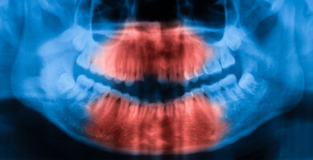 牙科x光全景图，正面图片下载