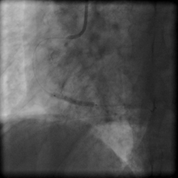 冠状动脉支架图片下载
