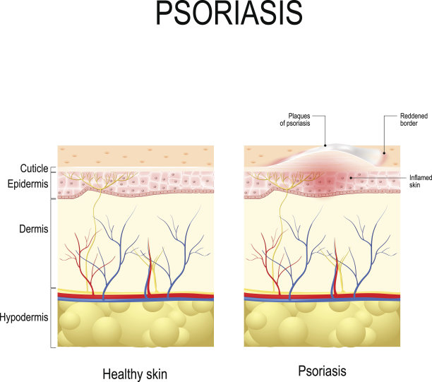 牛皮癣素材图片