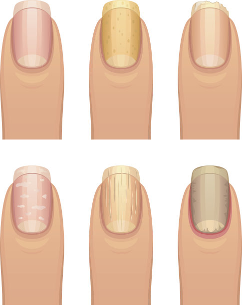 指甲疾病组图片下载