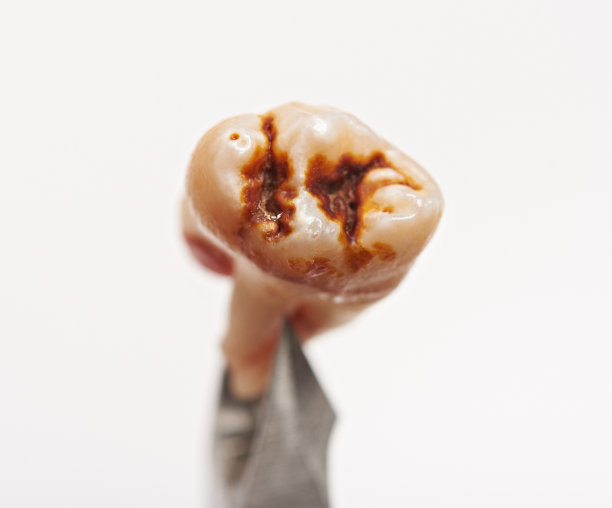 被蛀牙损坏图片下载