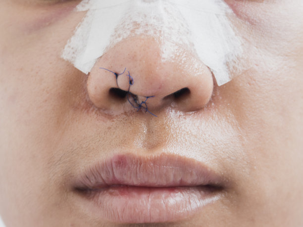 鼻子整形手术图片下载