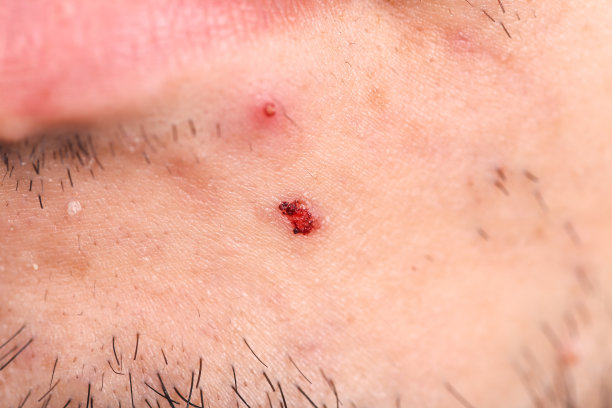 男性皮肤和痤疮疤痕图片下载