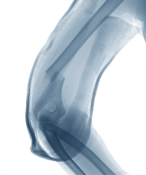 肱骨骨折的X线照片图片下载