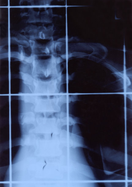 放射治疗x光图片下载