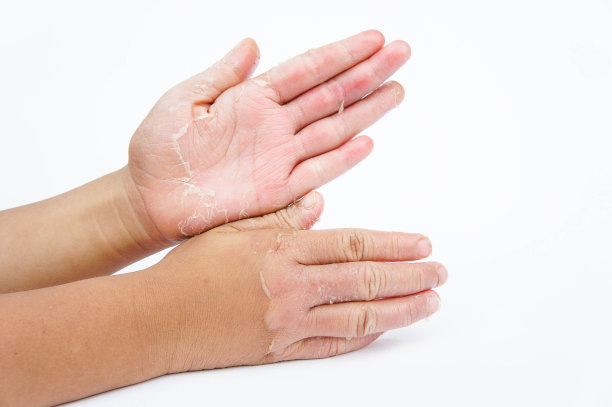 手干燥，脱皮，接触性皮炎，真菌感染，皮肤炎症素材图片