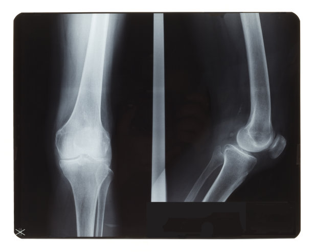 膝盖x光照片图片下载