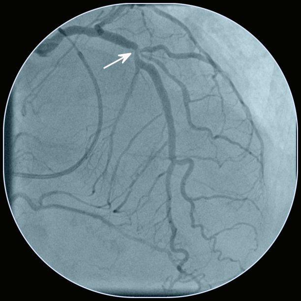 冠状动脉狭窄图片下载
