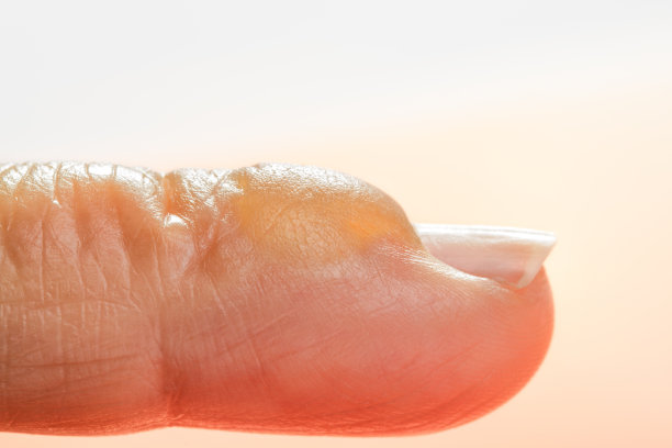 手指上有灼伤水泡图片下载