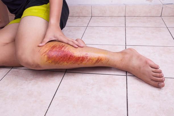 用手抱住摔伤的膝盖，膝盖有疼痛的擦伤图片下载