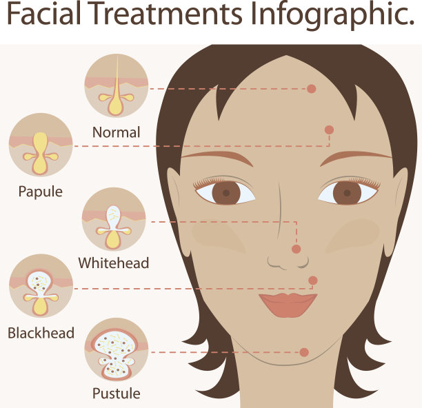 痤疮和丘疹的类型图片下载