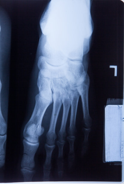 踝足及膝关节疼痛x线MRI照片图片下载