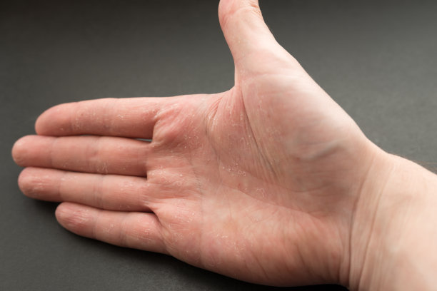 湿疹或过敏反应。素材图片